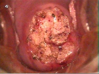Rahimde Yara Belirtileri ve Tedavisi Rahimde Yara Belirtileri ve Tedavisi