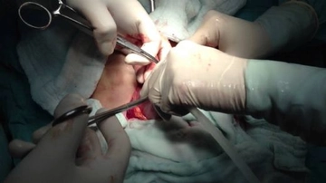 Rahimde Kitle Ameliyatı Riskleri ve Sonrası Rahimde Kitle Ameliyatı Riskleri ve Sonrası